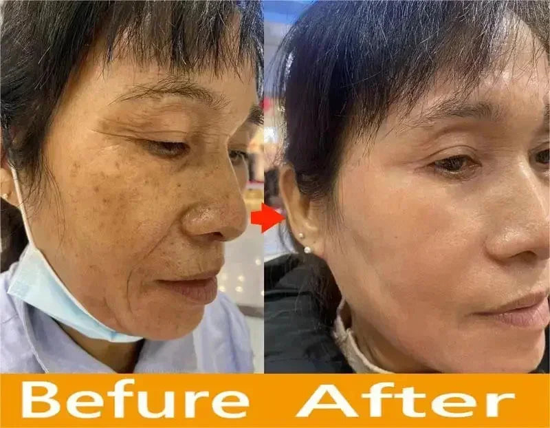 Dark Spots Remover Whitening Face Set Freckle Melanin Correcting Reduce Fine Lines Brighten Essence Korean Beauty Skin Care ﻿