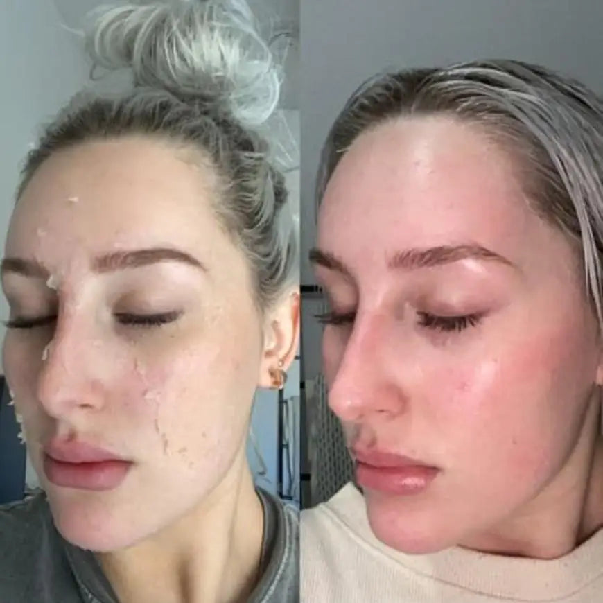 Acid Peeling Serum Chemical Exfoliant Peel for remove Face Dark Skin Spots Whiten Lighten Melanin Peeling Solution Skin Peel