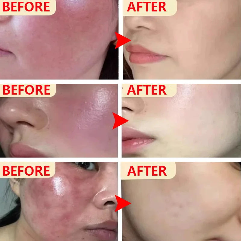 Instant Facial Redness Repair Cream Soothing Red Blood Rosacea Treatment Improve Sensitive Skin Anti Redness Skin Care Cosmetics