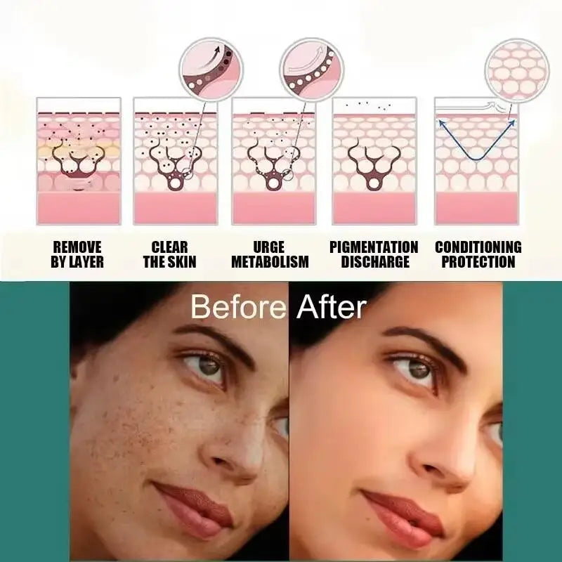 Powerful Spot-removing Whitening Freckles Cream Remove Melasma Dark Spots Fade Pigmentation Acne Moisturizing Brighten Skin Care
