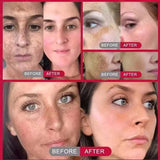 Powerful Spot-Removing Whiten Cream Brighten Skin Fast Eliminates Melanin Pigmentation Melasma Dark Spots Korean Face Skin Care